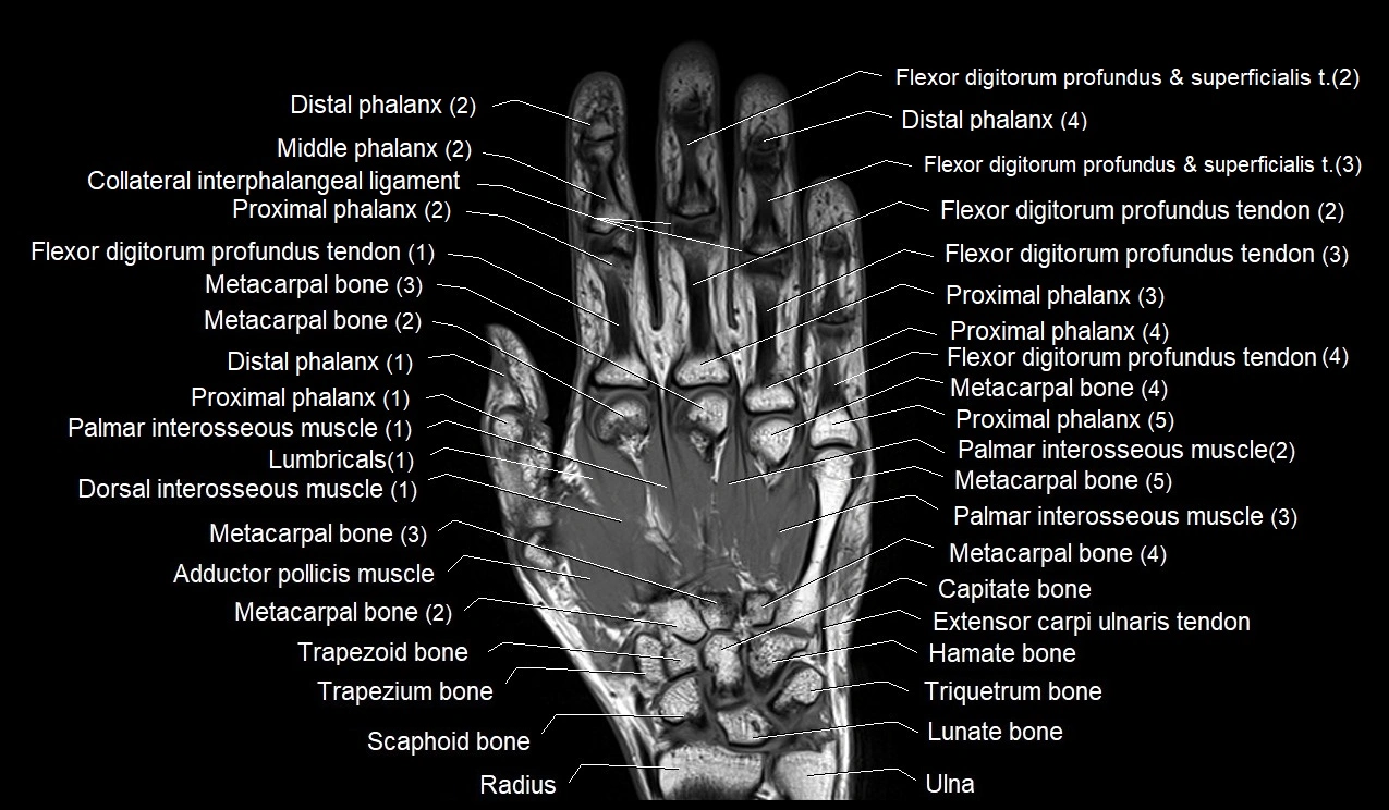 MRI 3T coronal hand cross sectional anatomy image 10.webp